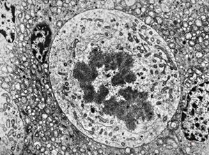 M,39y. | mitosis - chromophobic pituitary adenoma